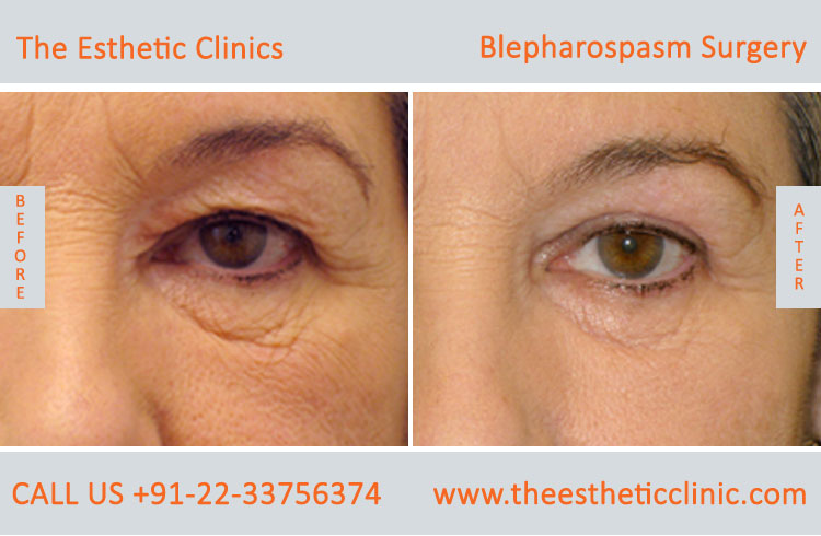 Blepharospasm Treatment, Eyelid Treatment before after photos in mumbai india (3)